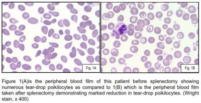 Figure 1(A)is the peripheral blood film of this patient before splenectomy showing numerous tear-drop poikilocytes as compared to 1(B) which is the peripheral blood film taken after splenectomy demonstrating marked reduction in tear-drop poikilocytes. (Wright stain, x 400)